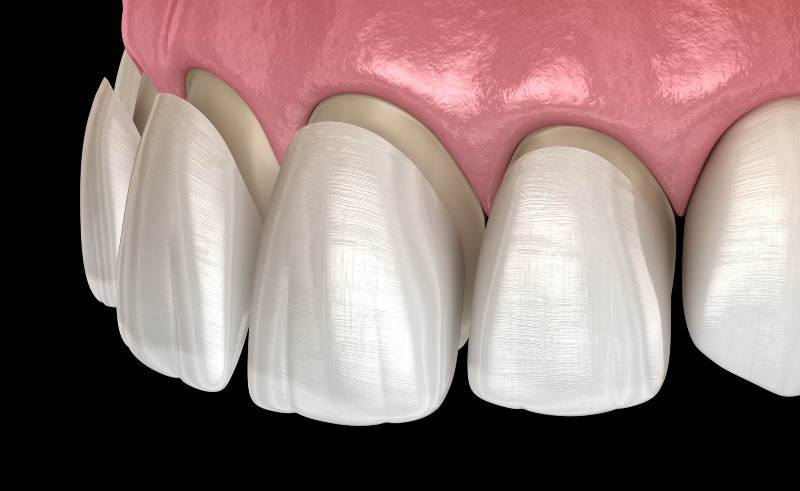 3D illustration of a composite resin filling procedure in Florence, KY & Tri-State area