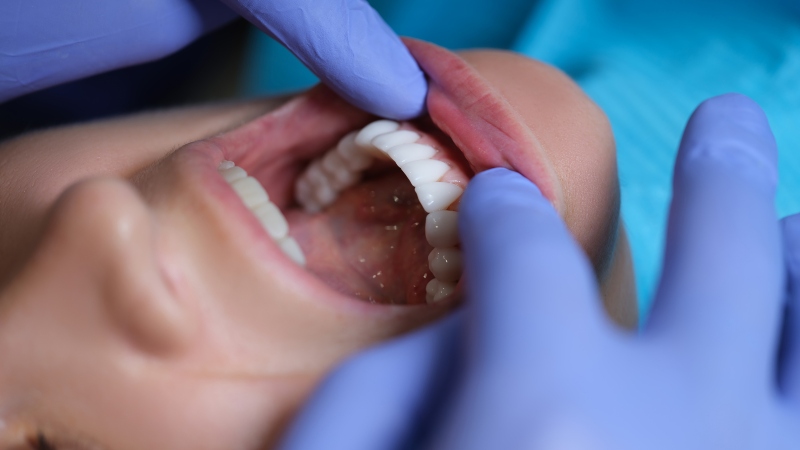 Dentist placing composite resin veneers in Florence, KY & Tri-State area