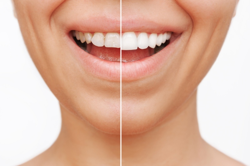 Smile showing before & after results of cosmetic veneers in Florence, KY & Tri-State area